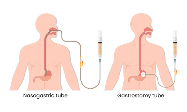 Illustration of tube feeding using a nasogastric tube or a gastrostomy tube, and showing a syringe used to deliver the feed.